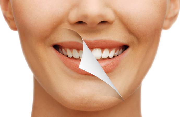 El blanqueamiento dental: siempre con tu dentista de confianza