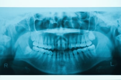 radiografía dental
