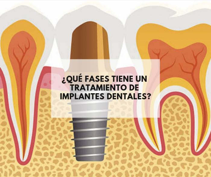¿Qué fases tiene un tratamiento de implantes dentales?