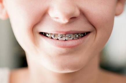 Ortodoncia infantil: ¿cuándo es recomendable?