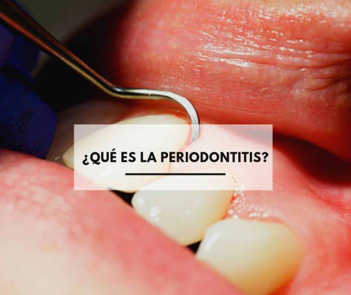 ¿Qué es la periodontitis?