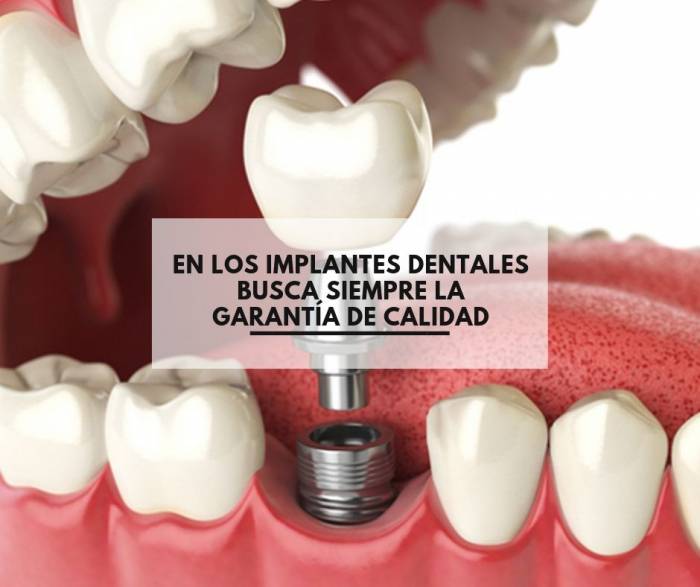En los implantes dentales busca siempre la garantía de calidad