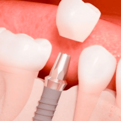 ¿Cómo es el postoperatorio de un operación de implantes dentales?